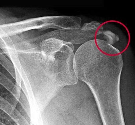 X-ray showed deposits of calcium salts in the joint