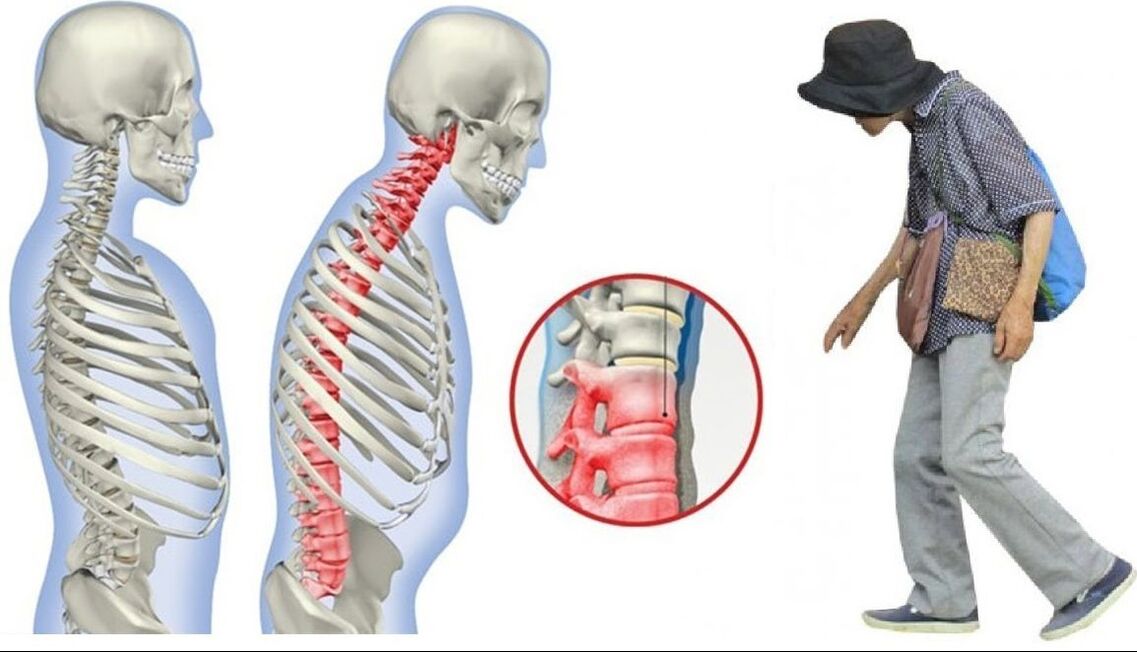 back pain due to ankylosing spondylitis