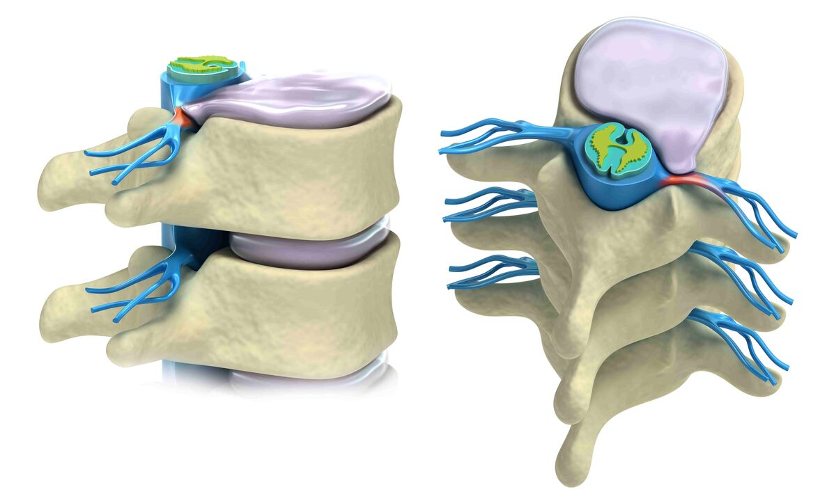 damaged spinal disc