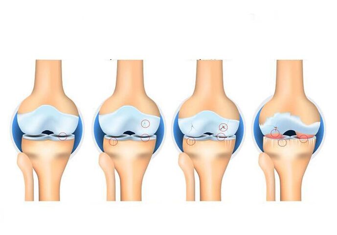 stages of arthrosis